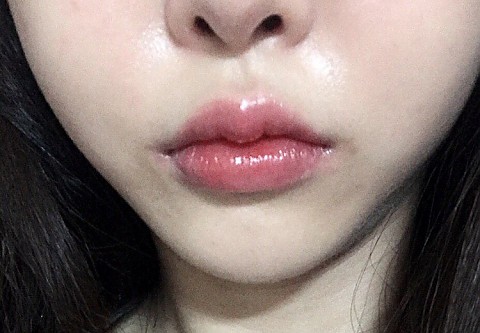 입술 필러  